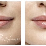 Restylane_Before and After_017_Lips_LR
