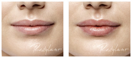 Restylane_Before and After_017_Lips_LR
